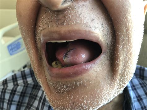Tongue cancer treated by surgery | The ENT Specialist