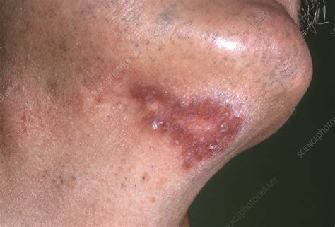 Discoid Lupus Erythematosus Stock Image C0522484 Science Photo