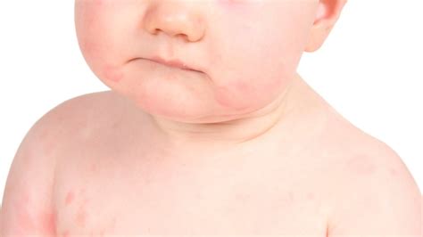 Baby Wipes Causing Itchy Rashes In Some Infants Study Nbc New York