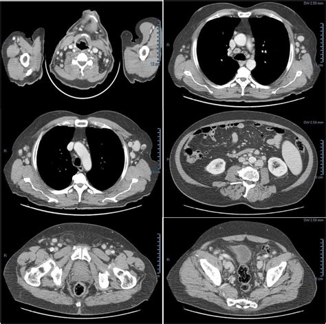 Case 1 Contrast Enhanced Ct Showing Multiple Hyperenhancing Enlarged