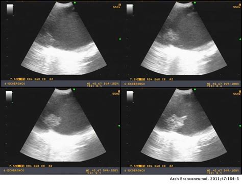Tromboembolia pulmonar trombosis venosa profunda. El tromboembolismo pulmonar visto por ultrasonografía ...