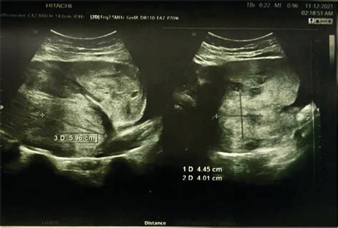 Ultrasound Scan Of The Uterus Showing A Large Blood Clot Seen At The