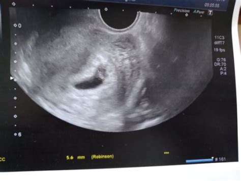 De là, le cerveau du foetus se développe à une vitesse grand v : Taille embryon à 7SA ? - Octobre 2018 - BabyCenter
