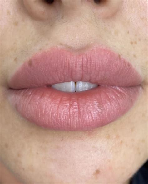 Lip Augmentation With Fillers In Sydney The Manse Clinic