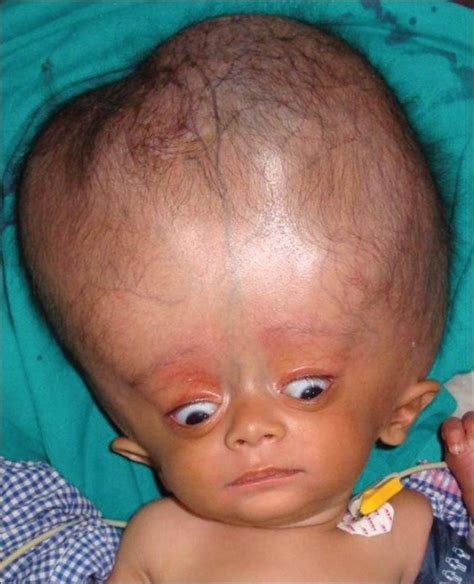 Hydrocephalus With Increased Head Circumference In A 3 Month Old Child