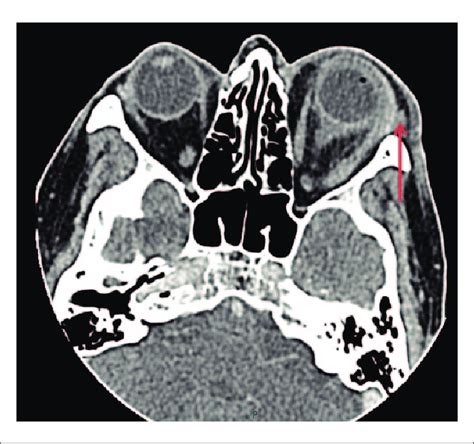 Ct Imaging Showing Left Proptosis With Infiltration Inflammation Of