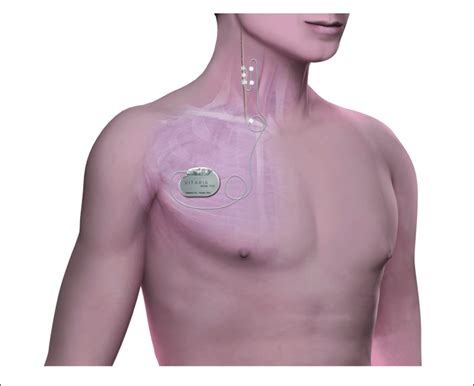 The Stimulation System Consists Of An Implantable Pulse Generator