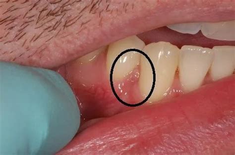 Gingival Cyst Of The Adult Gingival Cyst Treatment Bauer Smiles