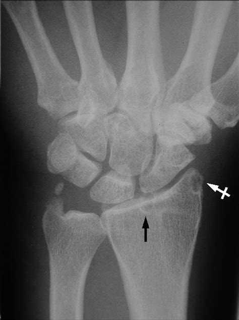 Pa View Of Right Wrist Reveals A Subchondral Cyst In Th Open I