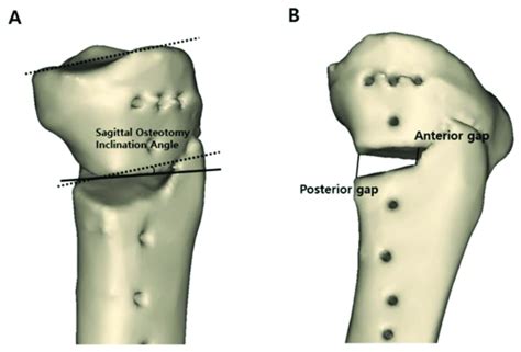 Measurement Of The Sagittal Osteotomy Inclination Angle And Anterior