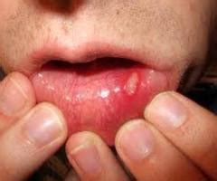 Cold sores spread through close human contact like kissing and oral sex. Mouth sores causes and home remedies - HealthVeda