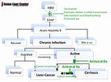 Hepatitis B Cancer Treatment Pictures