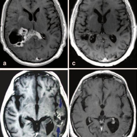 1 Primary Brain Tumor Distributions From Cbtrus Central Brain Tumor