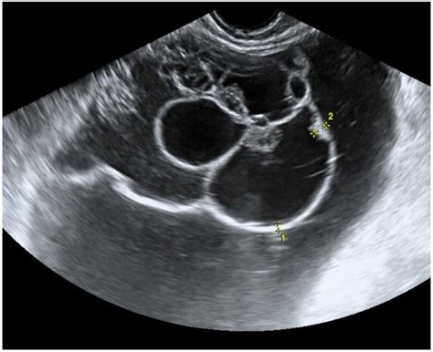 Ovarian Cancer Ultrasound Vs Normal Normal Ovary Ultrasound How To In General Tumors Can Be