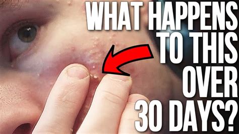 Pop That Zit Video