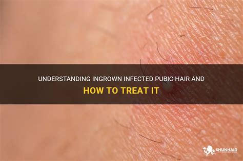 Understanding Ingrown Infected Pubic Hair And How To Treat It Shunhair
