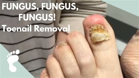 Fungus Fungus Fungus Toenail Removal Youtube