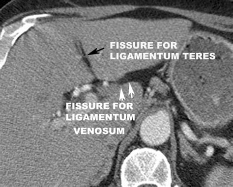 The ligamentum teres present in hip is also known as round ligament of the femur and ligamentum teres femoris. Course of Esophagus
