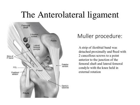 The Antero Lateral Ligament The Whole Story