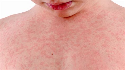 Delia Henderson Info Common Skin Rashes In Adults