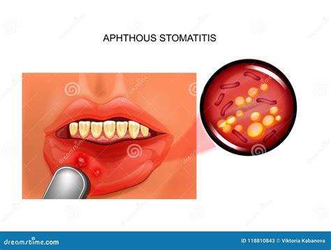 Candidiasis And Aphthous Stomatitis Vector Illustration 118643342