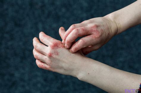 Dyshidrotic Eczema Affect Nails Nail Ftempo