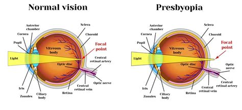 The Best Selling Contact Lenses For Presbyopia In Eyestyle