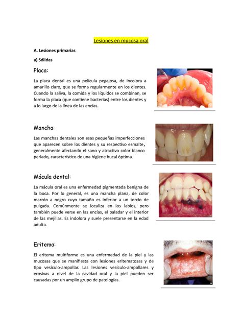 Lesiones Descritas En La Mucosa Oral Boca Lesiones En Mucosa Oral A