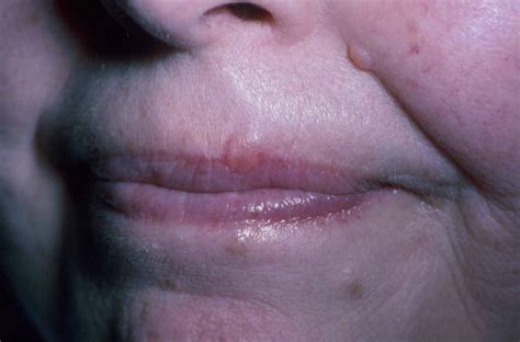 Mac On The Left Upper Lip Of An Elderly Woman Note The Close Clinical