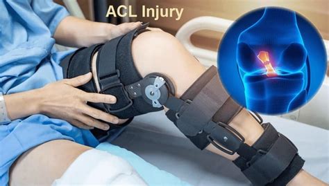 How To Prevent An Acl Injury Befit Physiotherapy