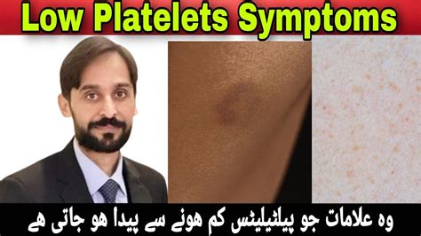 Symptoms Of Low Platelet Count Youtube