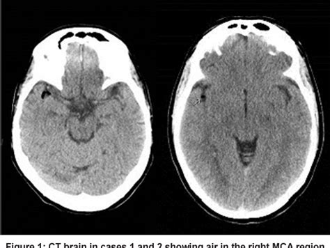 Figure 1 From Acute Ischemic Stroke Caused By Paradoxical Air Embolism