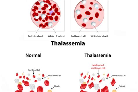 Living With Thalassemia