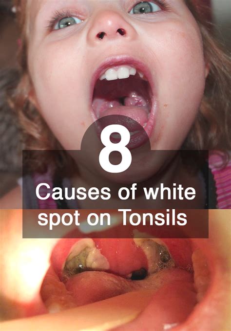 8 Causes Of White Spots On Tonsils