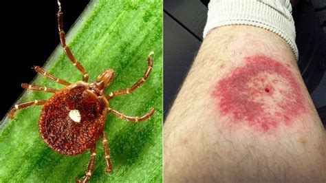 Picture Of Tick Lone Star Tick Bites Pest Hacks