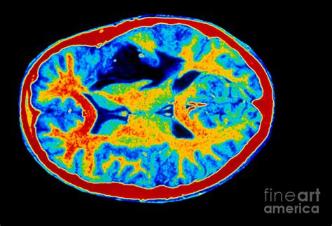 Colored Mri Scan Of Brain Cancer Photograph By Scott Camazine