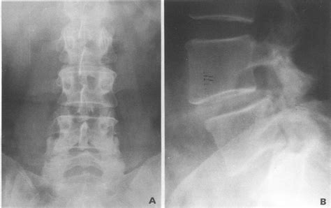 Present Patient Frontal And Lateral Radiographs Of The Lumbar Spine