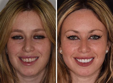 Before And After Smile Gallery Bedford Dental Group
