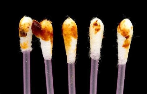 7 Signs Of Health Issues Your Earwax Could Reveal
