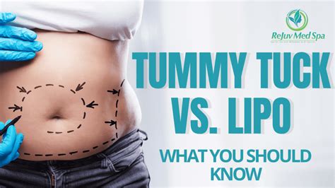 Tummy Tuck Versus Liposuction What You Should Know Rejuv Medspa Med Spa