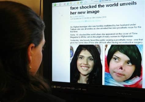 Disfigured Afghan Woman Gets Prosthetic Nose World News South And