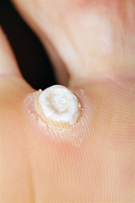 Verrucae And Warts Overview And Treatments Evolution Podiatry Evolution