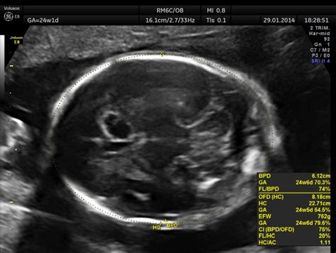 Choroid Plexus Cyst Looking Through A Transducer