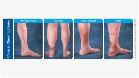 Chronic Venous Insufficiency Hd Png Download Kindpng
