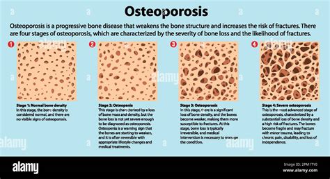 Bone Density And Osteoporosis Vector Illustration Stock Vector Image