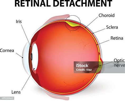 Retinal Detachment Vector Diagram Vektorgrafik Och Fler Bilder På