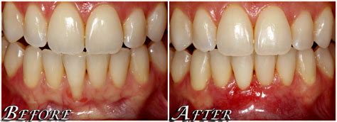 Receding Gums Also Known As Gum Grafting By The Center 4 Smiles