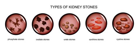Kidney Stones Everything You Need To Know About Them Medfin