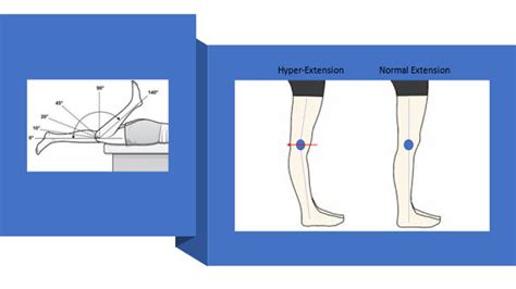 Knee Hyperextension Centeno Schultz Clinic
