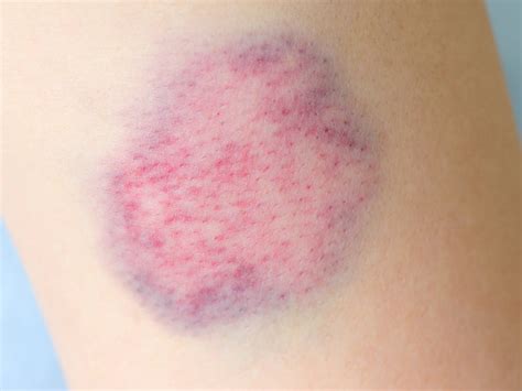 Bruise On Lower Lip Babycenter